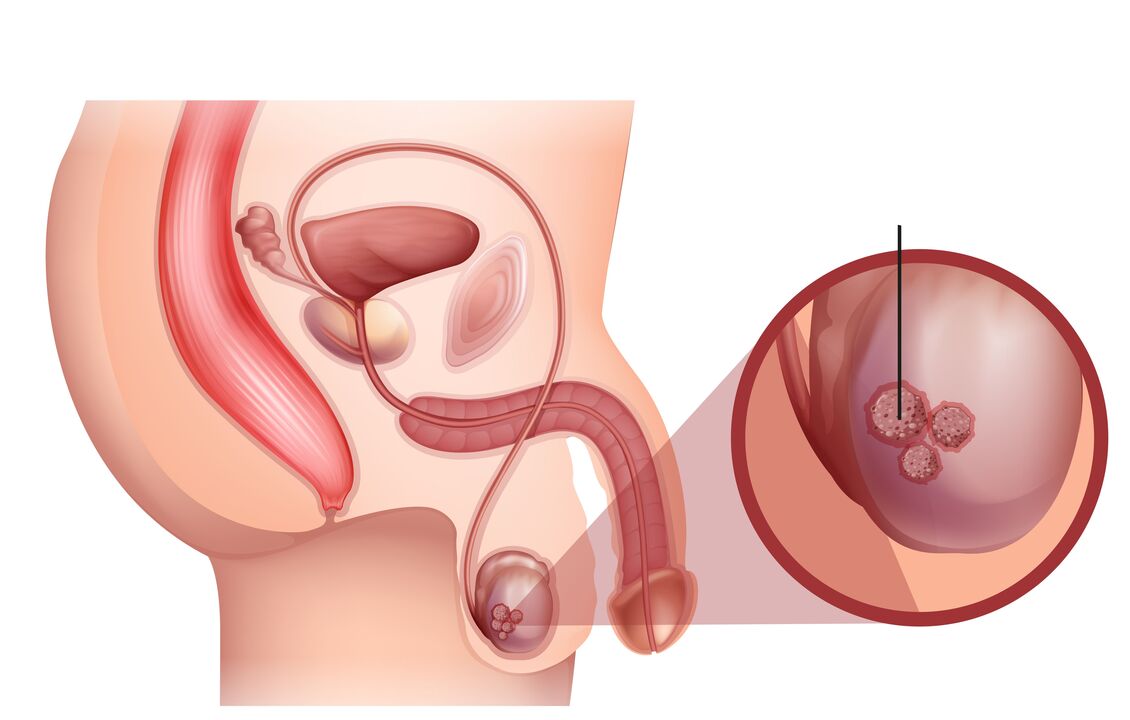prostatos vėžio požymiai
