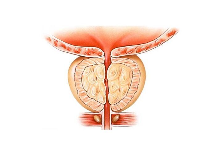 prostatito gydymas liaudies gynimo priemonėmis